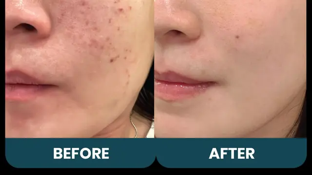 Hempaskan flek hitam di wajah