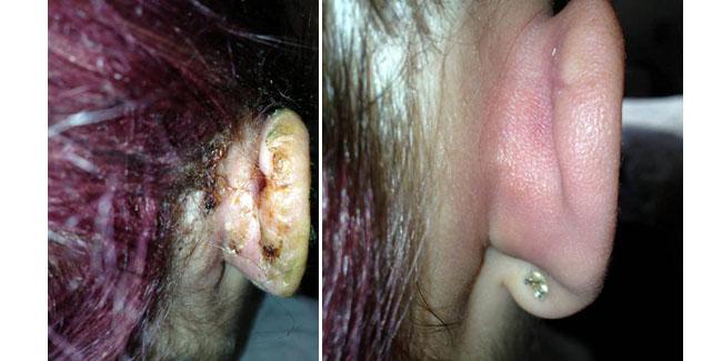 Kondisi telinga Bianca saat infeksi dan setelah operasi | Foto: copyright dailymail.co.uk