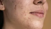ilustrasi jerawat akibat rusaknya skin barrier/copyright&nbsp;freepik.com/freepik