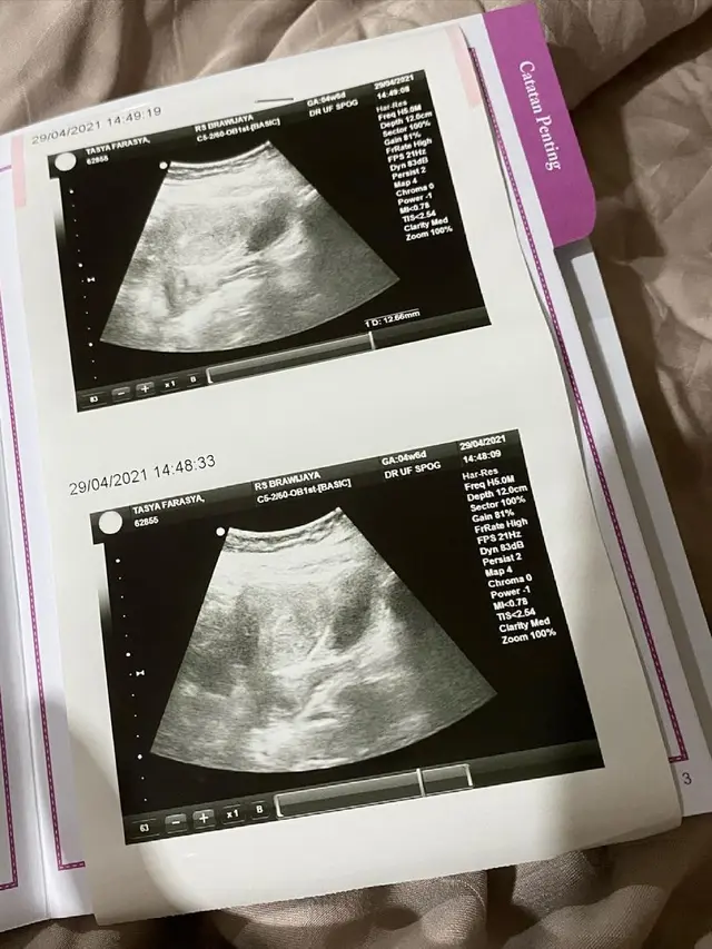 Keguguran Anak Kedua, Ini Potret Perjalanan Kehamilan Tasya Farasya
