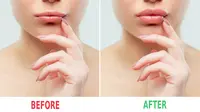Kondisi Bibir Sebelum dan Sesudah Menggunakan Cara Ini / Sumber: iStockphoto