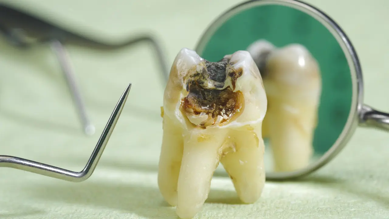 Karies Gigi dan Gigi Berlubang, Apa Bedanya?(Wolfiler/shutterstock)