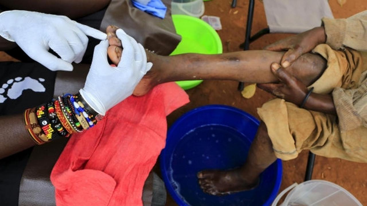 Derita warga Uganda terinfeksi kutu pengisap darah Jigger