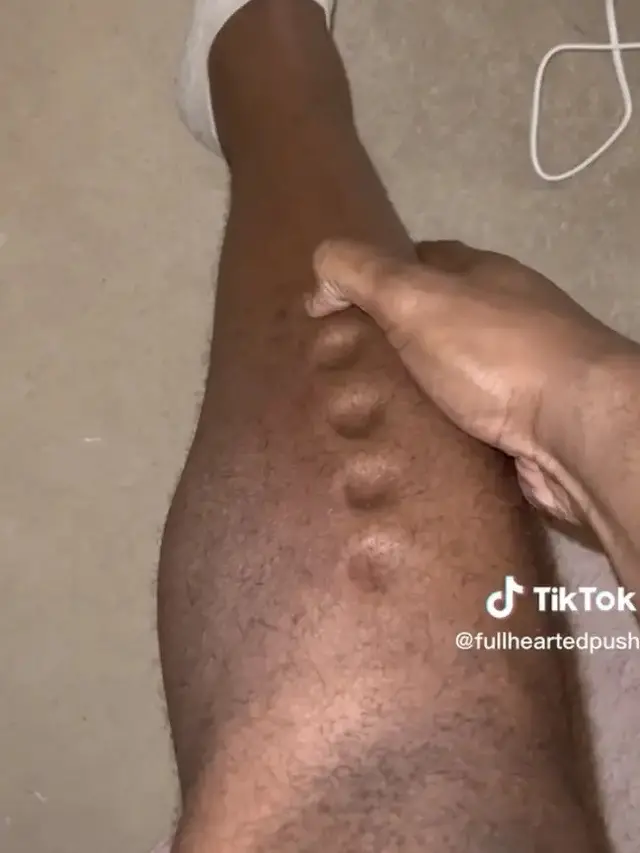 Kulit Jadi Lembek