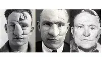 William M. Spreckley merupakan orang pertama yang berhasil dioperasi plastik bagian hidungnya akibat luka tembak. Source: Historybuff.com