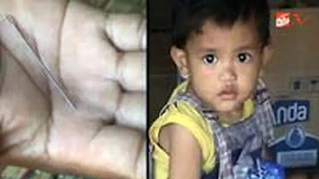 Ajaib, Tubuh Balita Ini Menyimpan Jarum!