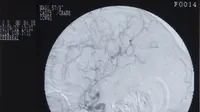 Ilustrasi Prosedur Brain Washing (Cerebral Angiography) (iStockphoto)