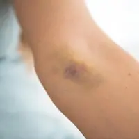 Cara Mengatasi Lebam yang Mudah Muncul