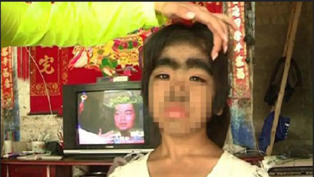 Xiao Ling, Terlahir dengan Rambut Berlebih di Seluruh Tubuh
