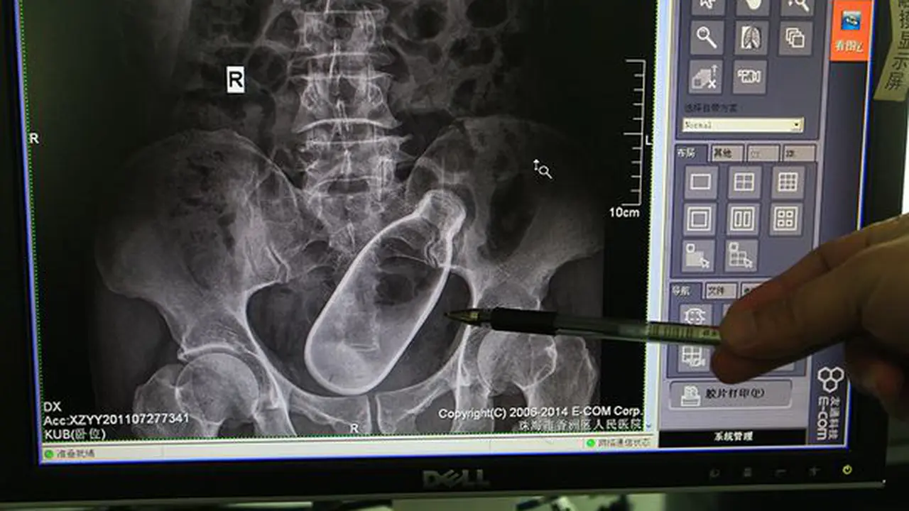 Foto Rontgen Perlihatkan Botol dalam Anus Pria
