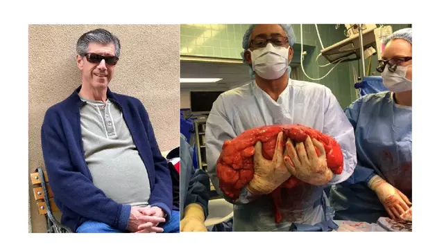 Disangka Lemak, Buncit Pada Perut Pria Ini Justru Tumor Ganas