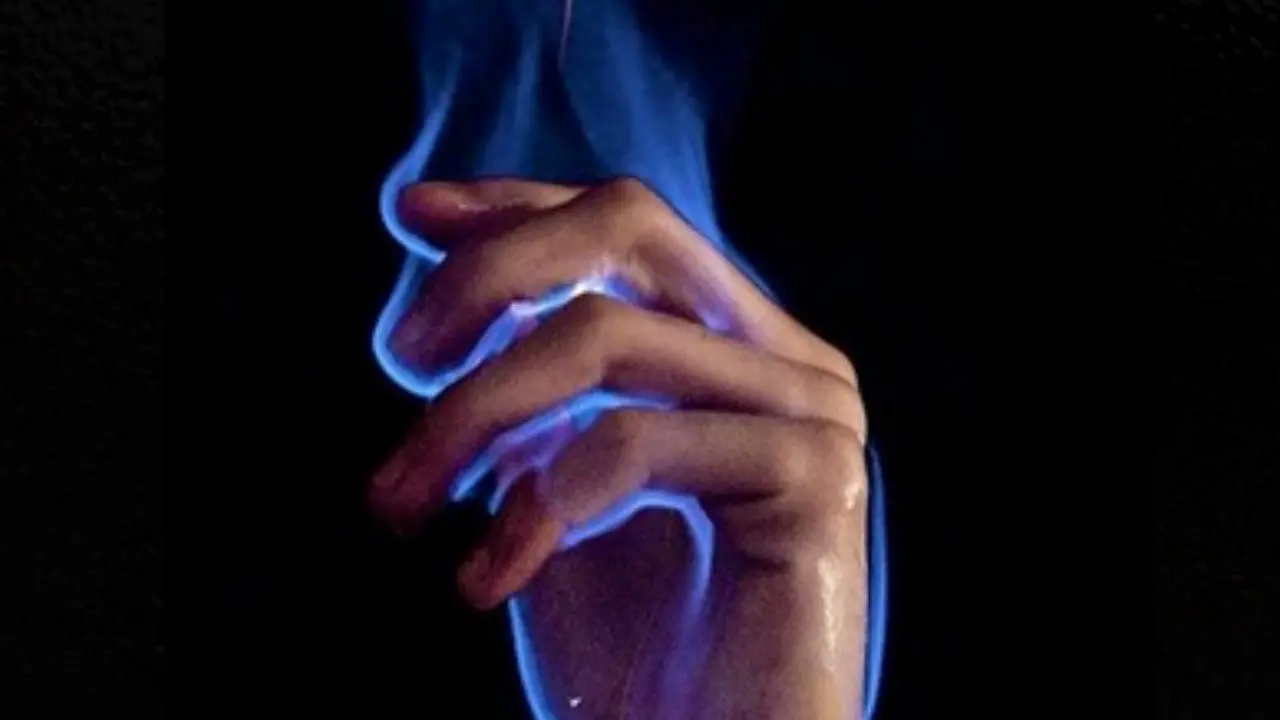 Luka bakar