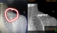 Pelajar SMP di Lampung Selatan Dibully Teman hingga Bahu Patah