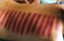 Tak Boleh Sembarangan, Ini Bagian Tubuh yang Harus Dihindari saat Kerokan
