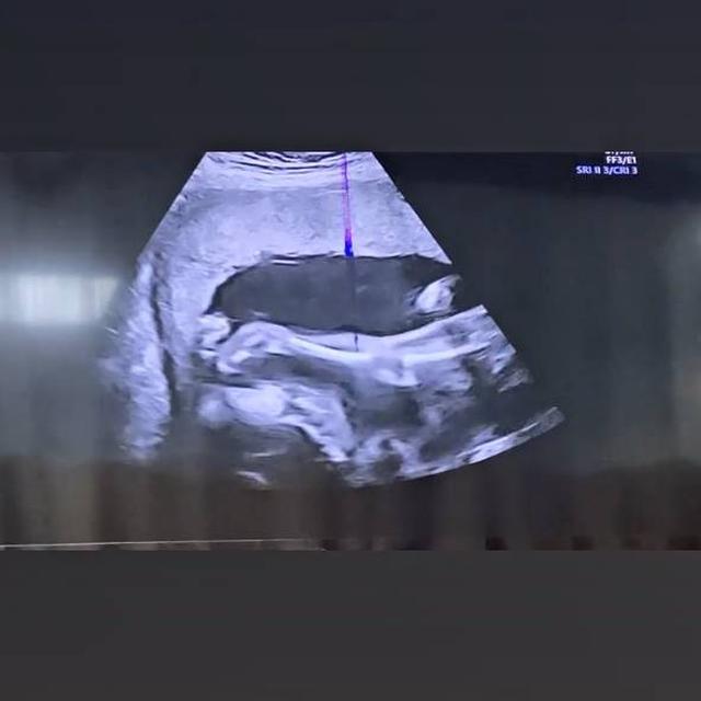 Tunjukan Hasil USG, Ini 6 Potret Uut Permatasari saat Periksa Kandungan