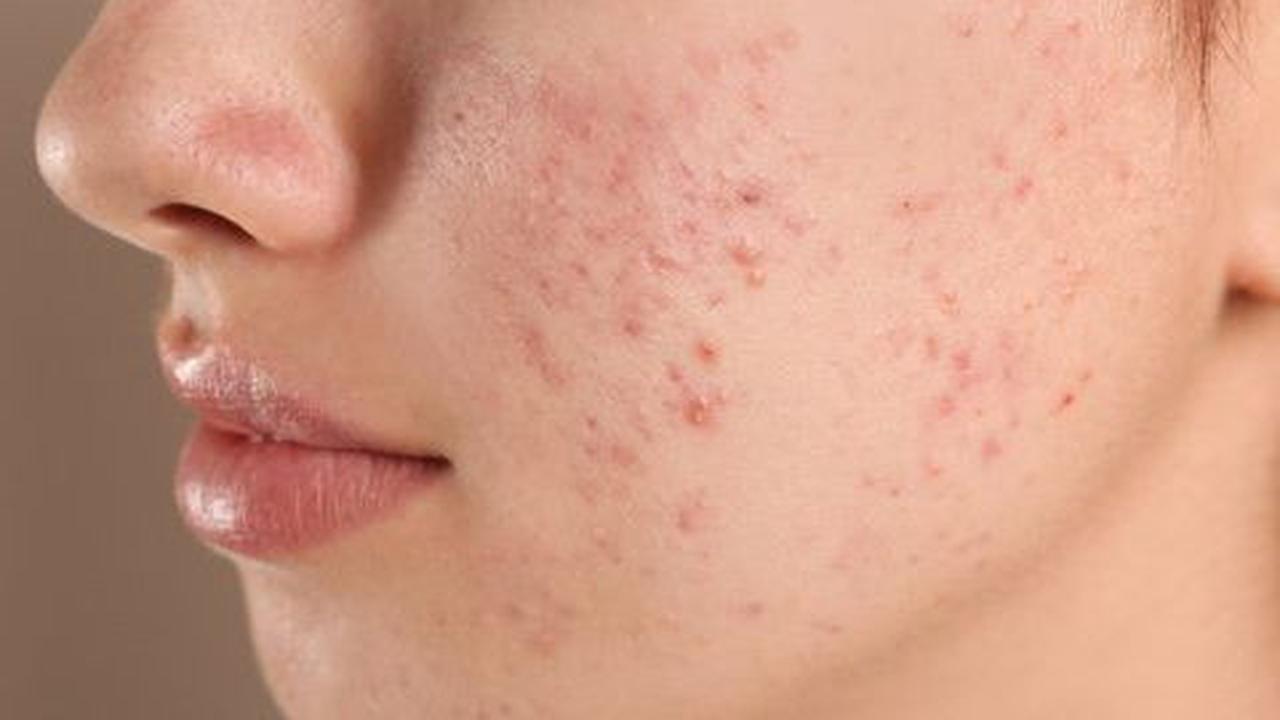 Cara Merawat Kulit Wajah Bruntusan secara Alami