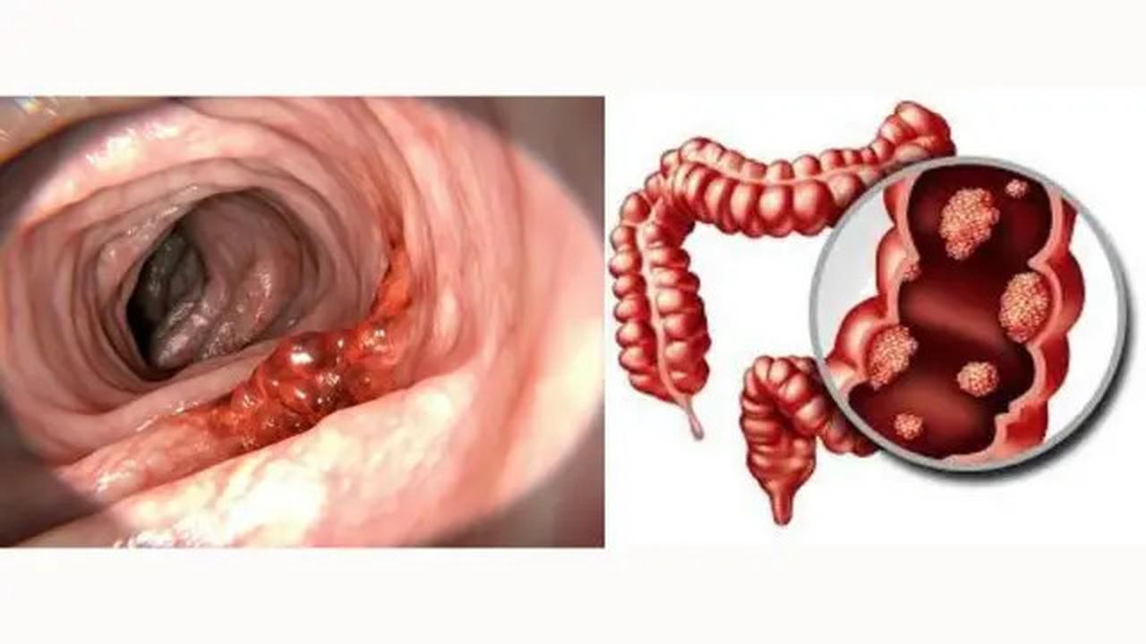 Fakta Seputar Kanker Kolorektal: Gejala dan Penyebab yang Harus Diwaspadai