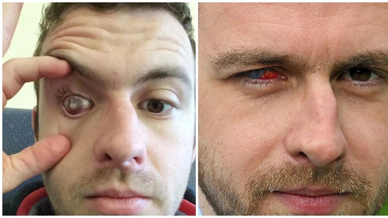 Tak Lepaskan Lensa Kontak Saat Mandi, Pria Ini Alami Kebutaan