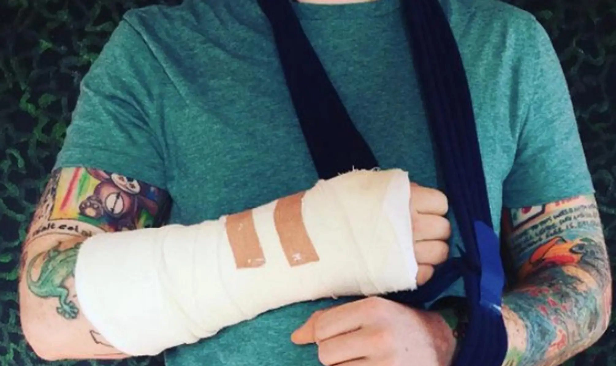 Kondisi Ed Sheeran yang mengalami patah tangan setelah kecelakaan (Daily Mirror)