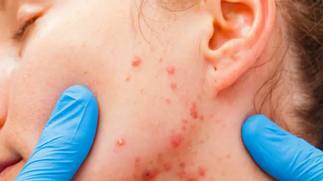 Ilustrasi jerawat membandel