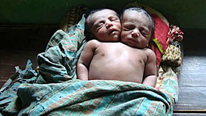 Saling Berbagi Tubuh, Bayi Ini Terlahir dengan Dua Kepala