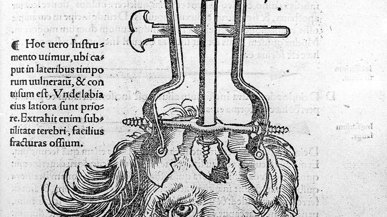 Trepanasi