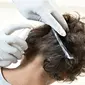 Piretroid dalam perawatan kutu rambut bisa memengaruhi otak anak. (Ilustrasi: Mail Online)