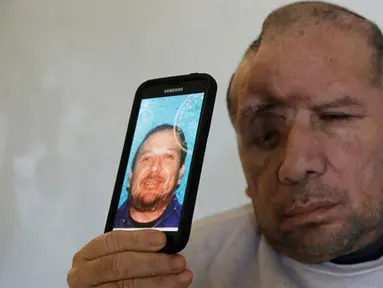 Walter DeLeon menunjukkan foto di SIM-nya di Covina, California, Rabu (2/12/2015). Pria 49 tahun itu kehilangan seperempat tempurung kepalanya setelah ditembak oleh petugas kepolisian Los Angeles pada 19 Juni lalu. (AP/Chris Carlson/Dailymail)