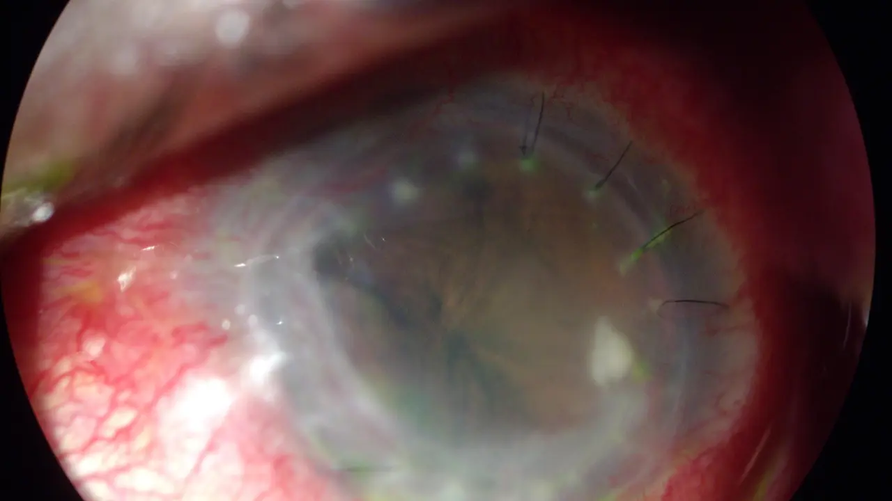 [Bintang] 5 Bulan Nggak Buka Softlens, Hal Mengerikan Ini Terjadi