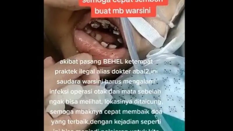 Warsini Pekerja Migran Indonesia (PMI) yang bekerja di Taiwan, mengalami infeksi otak dan kebutaan pada sebelah matanya, karena menggunakan kawat gigi (behel) abal-abal.