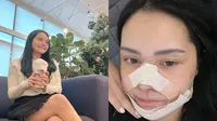 Potret Mawar AFI Oplas Hidung Kedua di Korea (Sumber: Instagram/mysamawar)