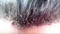 Video Ratusan Kutu 'Bergerilya' di Rambut Pria