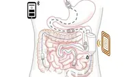 Ketika Robot Kecil Hidup di Dalam Perut untuk Keluarkan Insulin