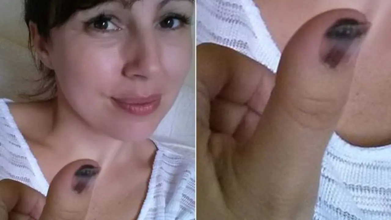 Gara-gara Tanda Hitam di Jempol, Wanita Ini Harus Amputasi Jariny
