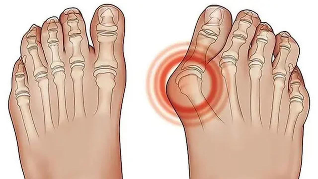 Ciri-Ciri Asam Urat di Kaki pada Malam Hari, Sakit hingga Sulit Jalan