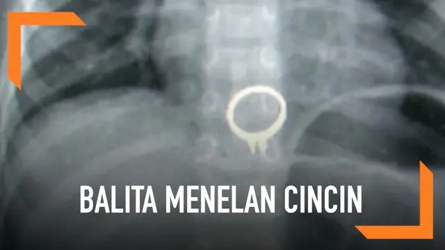 VIDEO: Balita Menelan Cincin Berlian Ibunya saat Bermain