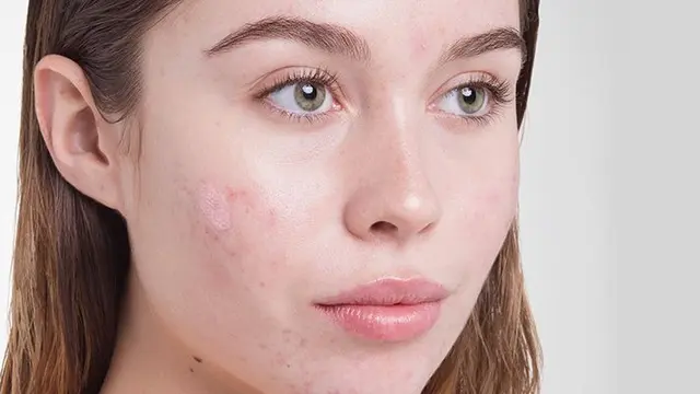 ilustrasi sabun susu kambing untuk jerawat/pexels