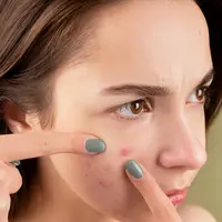 Jerawat dapat muncul akibat bahan-bahan aktif baru yang digunakan pada wajah. (Foto: Pexels/Anna Nekrashevich)