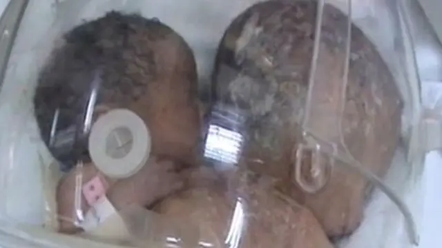 Bayi Kembar Siam Dempet Dada Lahir Secara Normal