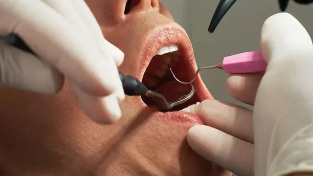 Menyamar Jadi Dokter, 4 Gigi Pria Ini Dicabut Oleh Petugas Kebersihan