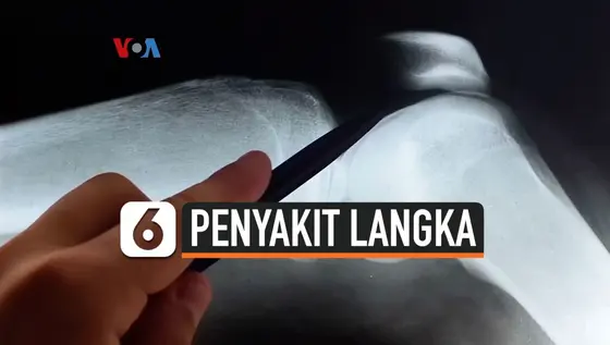 VIDEO: Penyakit Ini Bikin Lumpuh Mendadak Bila Penderita Tertawa