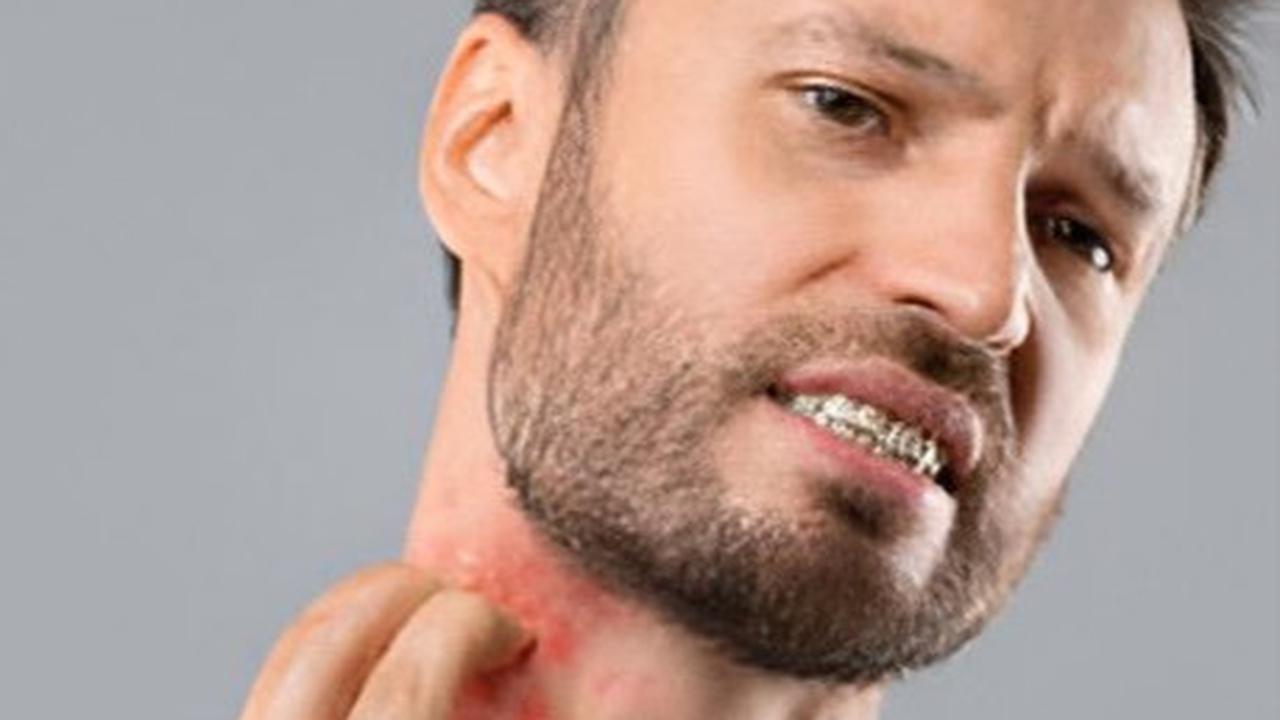 herpes