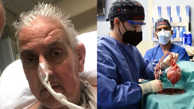Pria Jalani Transplantasi Jantung Babi