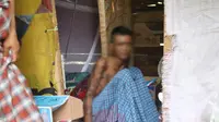 Sahabuddin (30) penderita kusta di Desa Tonyaman, Binuang, Polman (Liputan6.com/Abdul Rajab Umar)