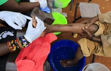 Derita warga Uganda terinfeksi kutu pengisap darah Jigger