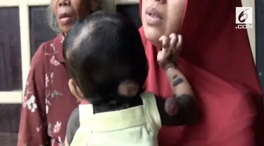 Bayi Arsila Nur Latifa menderita kelainan kulit sejak lahir, dengan ciri kulit menghitam hampir di sekujur tubuhnya.
