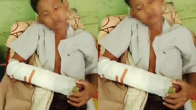 Bukan Perundungan, Ini Penyebab 2 Siswa SMP Berkelahi hingga Patah Tangan