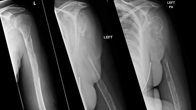 Derita Penyakit Langka Tulang Lengan Wanita Ini Tiba Tiba Hilang Global Liputan6 Com