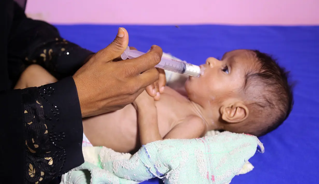 Seorang anak Yaman yang menderita malnutrisi menerima perawatan di sebuah rumah sakit di kota Hodeidah, Yaman (8/4). Pada akhir tahun 2017 lebih dari satu juta anak-anak menderita kekurangan gizi di tengah wabah kolera di Yaman. (AFP Photo/Abdo Hyder)