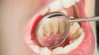 Mau Punya Gigi Bersih? Ini 3 Tips Membersihkan Karang Gigi / copyright shutterstock